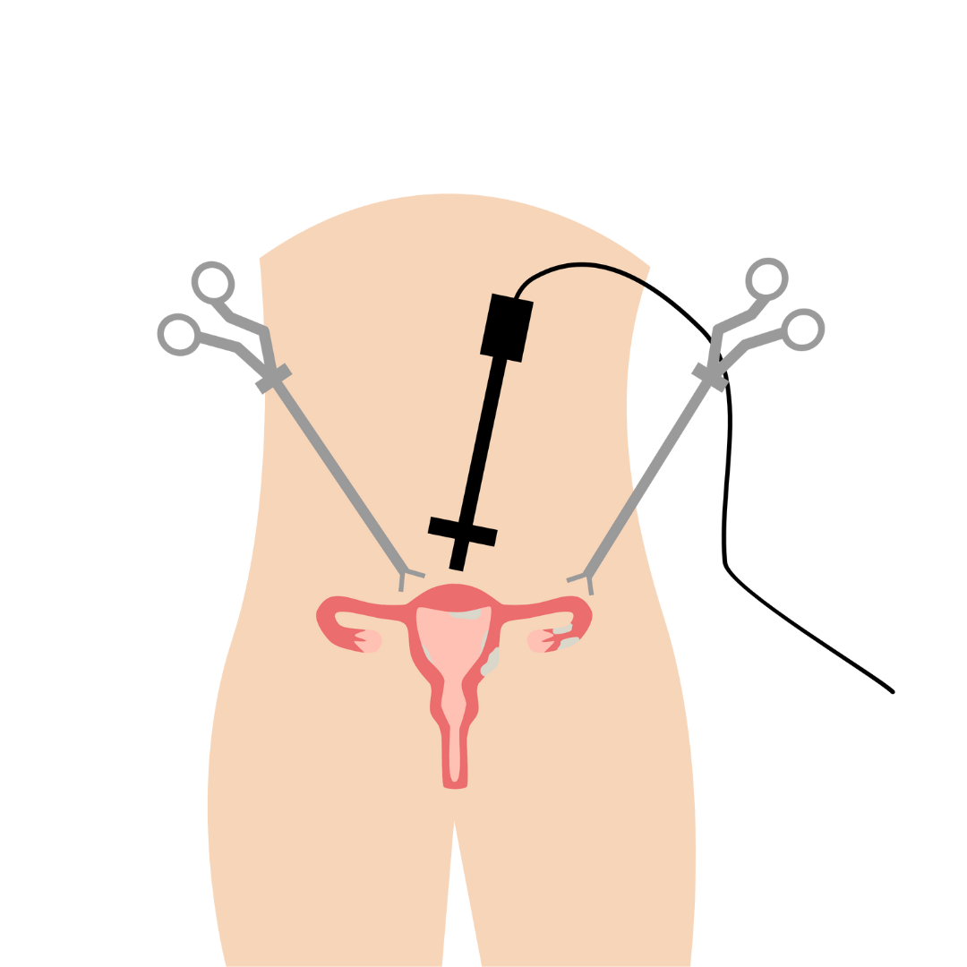 laparoscopic surgery Dr. Serajoom munira